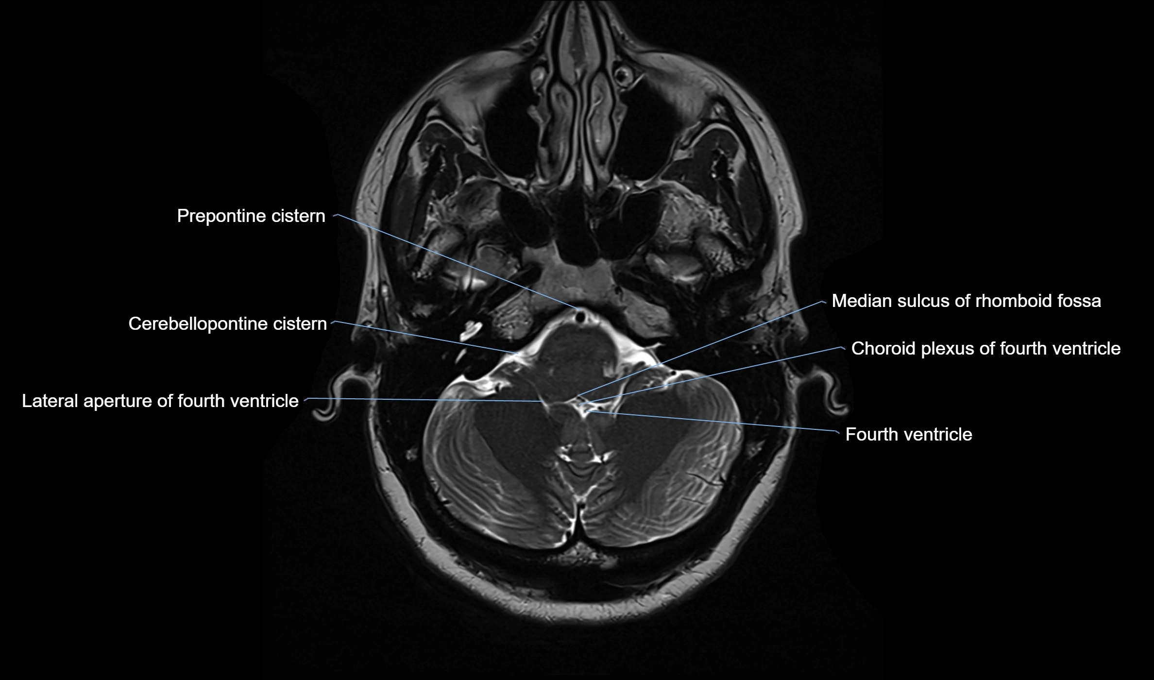 Brain cisterns  and ventricles  axial anatomy 3T MRI image-img-00001-00010.webp